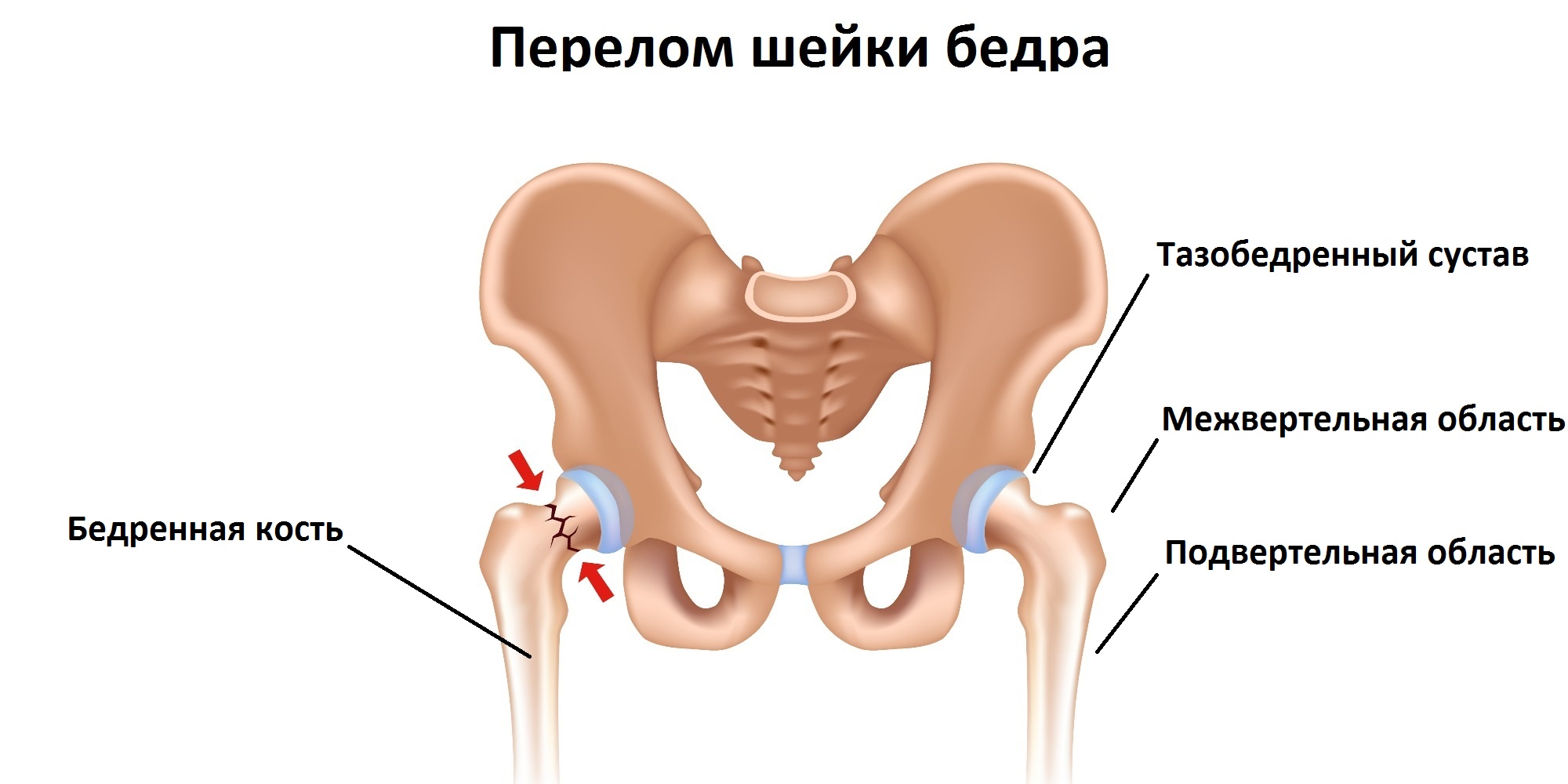 Догляд за хворим після перелому шийки стегна
